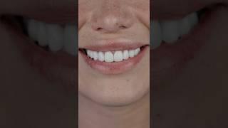 NEW smile is just TWO visits  | Smile Texas #veneers #porcelainveneers #dentist #teeth #newsmile