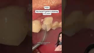 Getting a teeth cleaning after 5 years. #teethcleaning #tartarremoval  #plaque #tartar