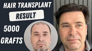 Hair Transplant Before and After 5000 Grafts Result 12 months | Hair Transplant Turkey 5000 Grafts