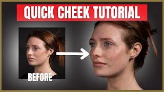 Quick Cheek Filler Tutorial | Cheek Dermal Filler Injection Advice