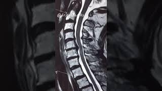 MRI of Spine - multiple lesion of 57 year old || Dr.pratap ks