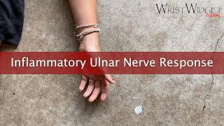 Inflammatory ulnar nerve response