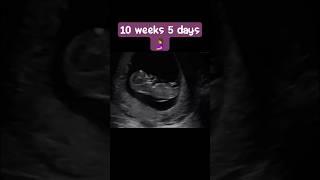 Ultrasound showing baby at 10 weeks 5 days #baby #pregnancy #mother #shorts