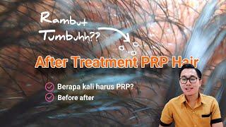 The Hair Grows Again?? | After Treatment PRP Hair for Hair Loss dr. Irfan Prasetya