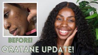 ONE THING ABOUT MY SKIN?! IT'S UP!! ORATANE UPDATE #2