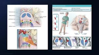 Lateral SCIT Approach for Resection of a Peduncular Midbrain Basilar Pontine Cavernous Malformation