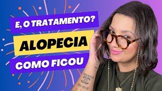 Alopecia Androgenética | Tratamento MAIO 2023 - Decidi não tomar medicação!