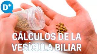 Causas y síntomas de los cálculos de la vesícula biliar