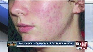 Some acne treatments cause side effects