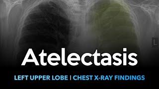 Atelectasis (Left Upper Lobe): Explanation of Chest X-ray Findings