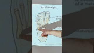 What is Metatarsalgia and where does it hurt the most? #shorts