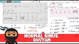 Rate and Rhythm | Normal Sinus Rhythm