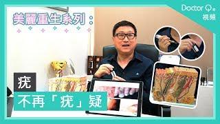 Doctor Q 美麗重生系列：疣 - 不再「疣」疑 普通科鍾家輝醫生