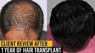 Client Review after 1 Year of Hair Transplant- Je Amour |  hair loss hair transplant results