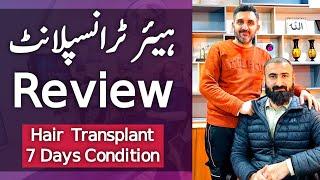 Hair Transplant SHOCKING Results! 7-Day Transformation | HONEST Review (Peshawar, Pakistan) | 2024