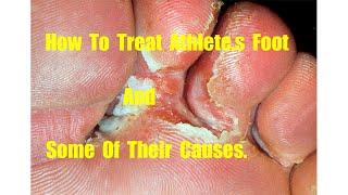 How To Treat An Athlete,s Foot And Some Of Their Causes(Emmeco Health Media)