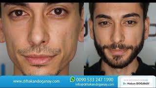 2800 Grafts Beard Transplant Before and After I Dr. Hakan Doganay TURKEY