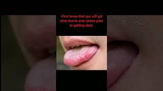 How to get heal of ulcer in tongue.#ulcer #tongue
