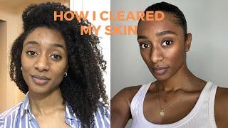 How I Cleared My Skin | Preventing Cystic Acne & Healing Dark Spots