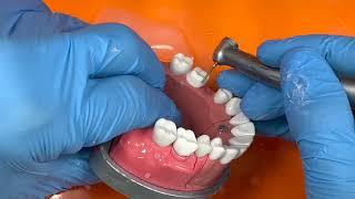 Adex full metal preparation bridge tooth #3