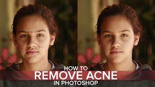 How to Remove Acne with Spot Healing Brush in Photoshop