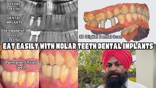 Zero pain Dental Implants | Eat same day of treatment | Cheema Implants Jalandhar