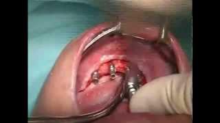 LIVE OPERATION Implantation using a Torque Ratchet