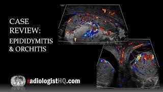 Ultrasound of Epididymitis & Orchitis