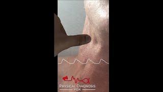 Normal Carotid Pulse (Narrated)