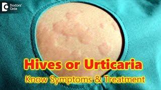 Hives | Urticaria-Causes,Symptoms,Treatment | Skin Rash | Allergy - Dr.Rasya Dixit | Doctors' Circle