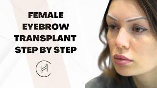 Eyebrow Transplant Procedure for Female Patient - Heva Clinic #eyebrowtransplant