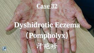 Dyshidrotic Eczema, Pompholyx,  汗疱疹