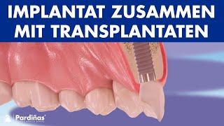 Implantat zusammen mit hart und weich Gewebe transplantaten ©