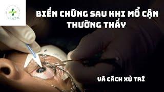 Biến chứng sau khi mổ cận và cách xử lý? Complications after surgery and how to handle?