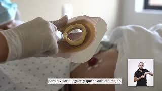 ¿Cómo cambiar la bolsa y barrera de Ostomía?