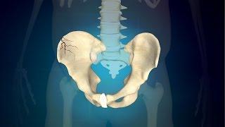 3 Simple Exercises for Pelvic Fracture to Regain Regular Function