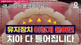 교정 후 유지장치 기간 및 부착 위치 (유지장치 떨어짐,wraparound retainer, fixed ratainer, relapse)