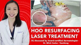 HOO RESURFACING LASER TREATMENT - FRACTIONAL CO2 LASER