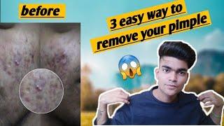 How To Get Rid of a pimple and Acne in 4 week | Fast Treatment | Hindi | Skin Care Tips