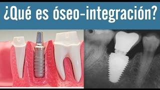 Qué es oseointegración |  Juan Fernando Salgado | La oseointegración de los implantes dentales