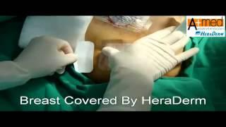 Breast Covered By HeraDerm 2