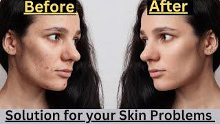 How to remove Pimple overnight | Acne Treatment #skincare #flp