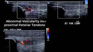 Knee Ultrasound basics - dynamic tests for anterior knee and ITB & identifying collateral ligaments