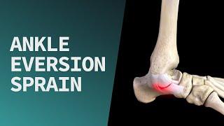 Ankle Eversion Sprain