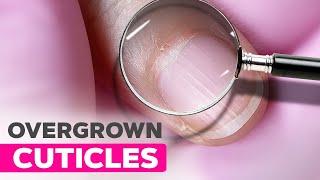 How to Fix Cracked Cuticles | Removing Overgrown Cuticles