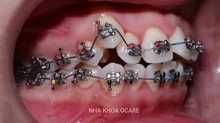 Braces process in 2 years