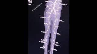 LOWER LIMB ANGIO VRT AND LABELING... IN CT ANGIOGRAPHY.....#RADIOLOGY#