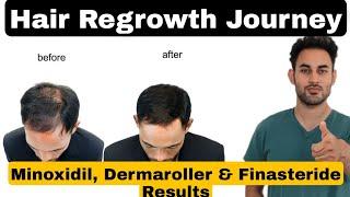 How you can achieve Hair Regrowth: Minoxidil, Dermaroller and Finasteride Journey #haircare