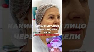 Лицо через 2 недели после процедуры #фотоомоложение #beauty
