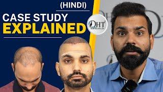 Best Hair Transplant result 2022 | Case Study Explained | NW Grade VI | Regrow Clinic Haridwar